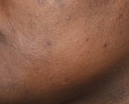 Understanding Post Inflammatory Hyperpigmention, the cause and treatment.