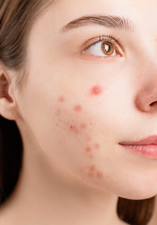 Acne & Congestion